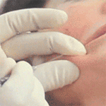 DermaSculpt Microcannula introduction