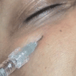 DermaSculpt Microcannula introduction