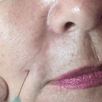 DermaSculpt Microcannula introduction